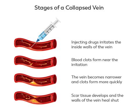 what happens when a vein blows up